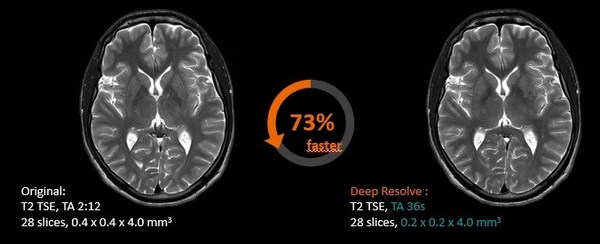 Deep Resolve可將顱腦掃描時間降低70%，并將成像分辨率提高2倍，并可保持相同的圖像質(zhì)量